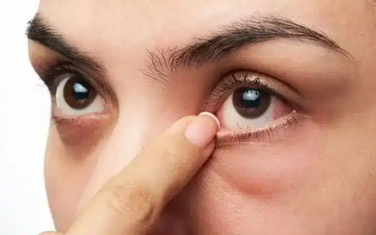 7 Ciri-Ciri Mata Kering yang Wajib Anda Ketahui Sebelum Terlambat