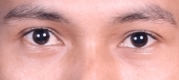 Mata Merah Tapi Tidak Sakit dan Gatal Bisa Jadi Anda Terkena Konjungtivitis